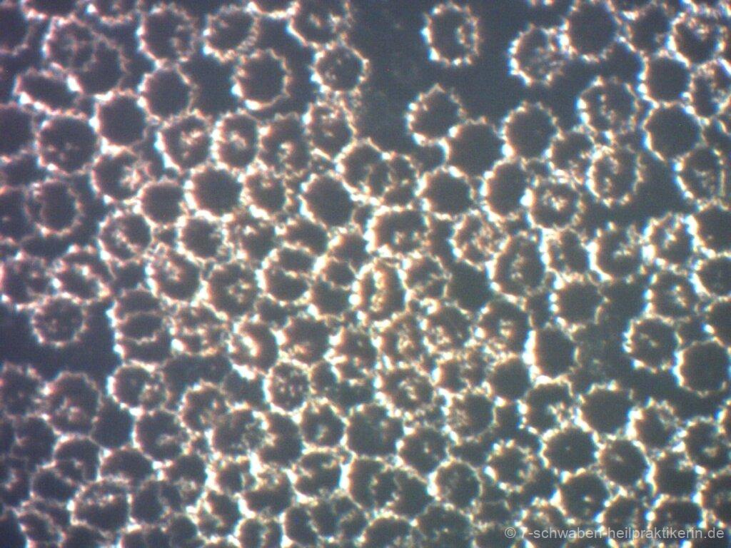 Rote Blutkörperchen in Stechapfelform (Echinozyten) unter dem Dunkelfeldmikroskop.
